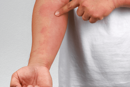 What Is Eczema – Atopic Dermatitis Causes, Triggers And Symptoms