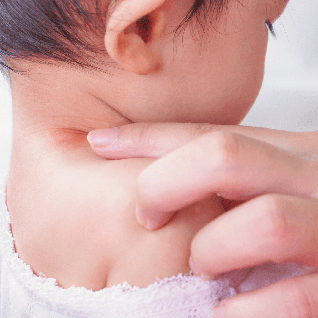 Trigger Scream What Is Eczema – Atopic Dermatitis Causes, Triggers And Symptoms ...