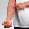 man with symptoms of eczema on his arm